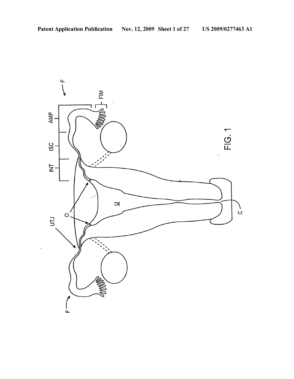 Deployment Actuation System for Intrafallopian Contraception - diagram, schematic, and image 02