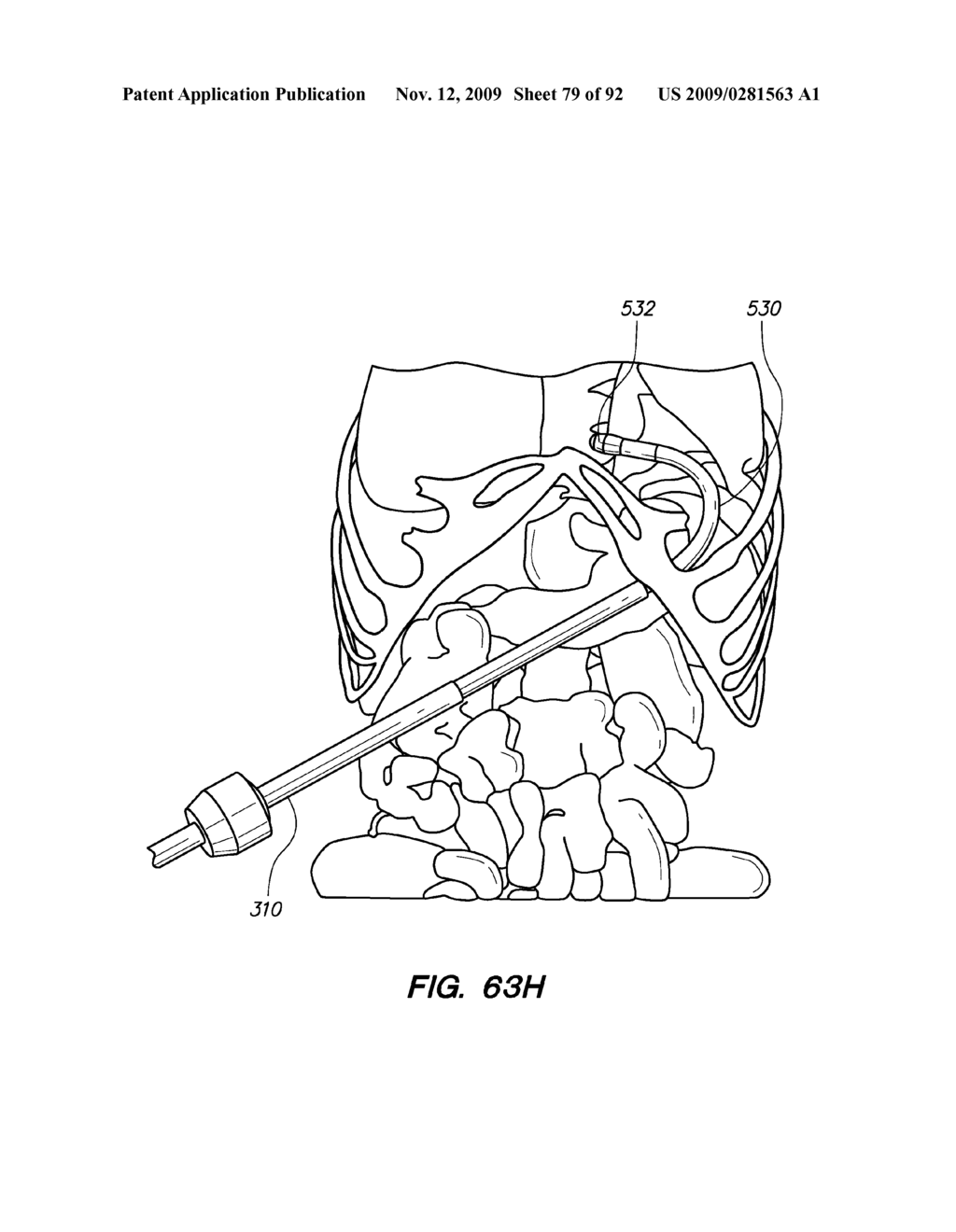 DEVICES, TOOLS AND METHODS FOR PERFORMING MINIMALLY INVASIVE ABDOMINAL SURGICAL PROCEDURES - diagram, schematic, and image 80