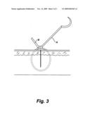 Gliding Stitch for Closing Wounds Under Tension diagram and image