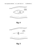 Gliding Stitch for Closing Wounds Under Tension diagram and image