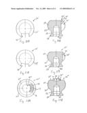 ULNAR HEAD PROSTHESIS SYSTEM diagram and image