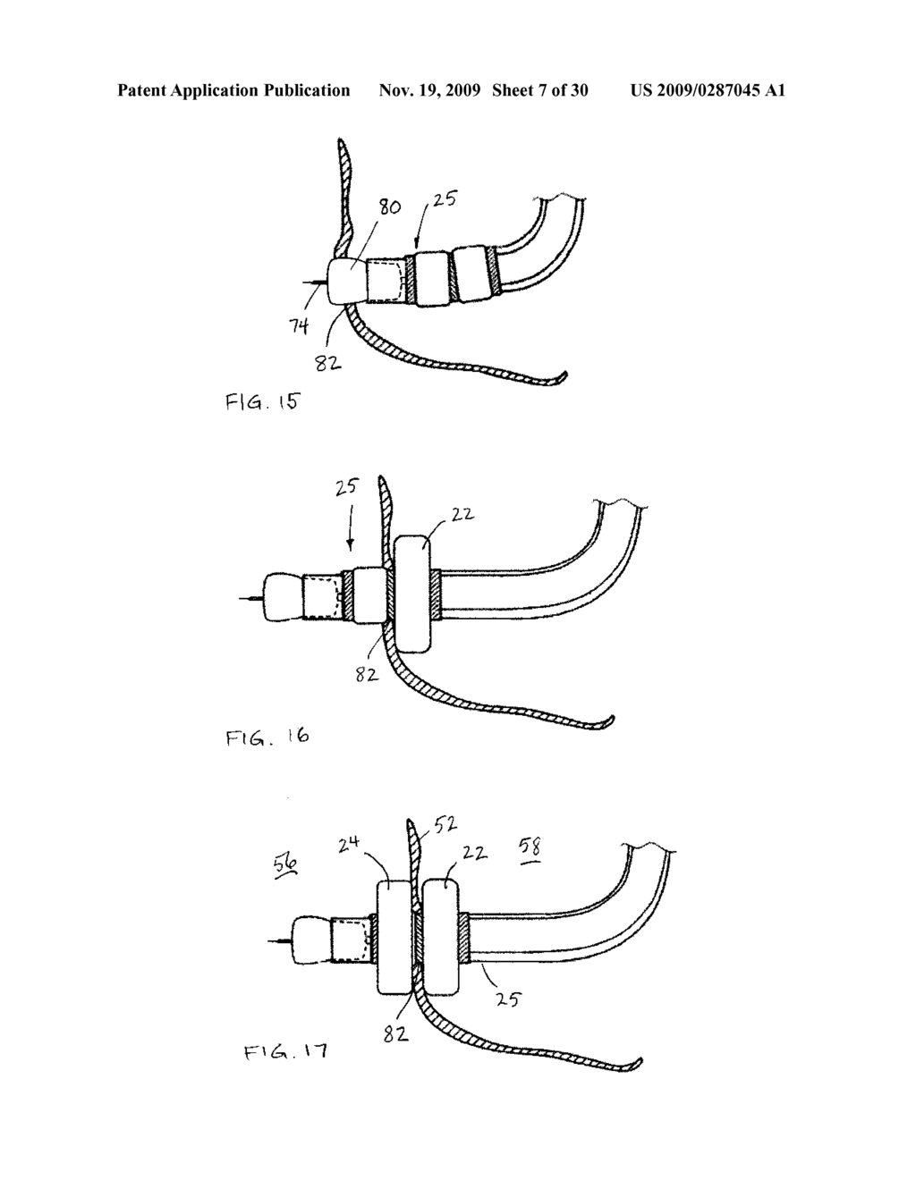 Access Systems and Methods of Intra-Abdominal Surgery - diagram, schematic, and image 08