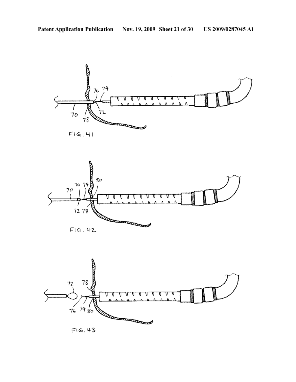 Access Systems and Methods of Intra-Abdominal Surgery - diagram, schematic, and image 22