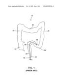 Device to facilitate suctioning of fluid during gastrointestinal endoscopy diagram and image