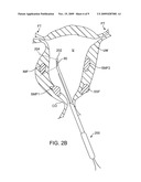 SUBMUCOSAL FIBROID ABLATION FOR THE TREATMENT OF MENORRHAGIA diagram and image