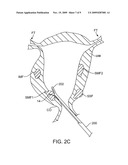 SUBMUCOSAL FIBROID ABLATION FOR THE TREATMENT OF MENORRHAGIA diagram and image