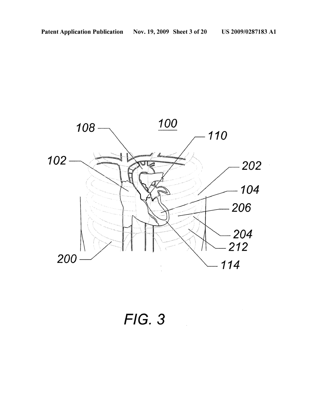 EXPANDABLE TRANSAPICAL SHEATH AND METHOD OF USE - diagram, schematic, and image 04