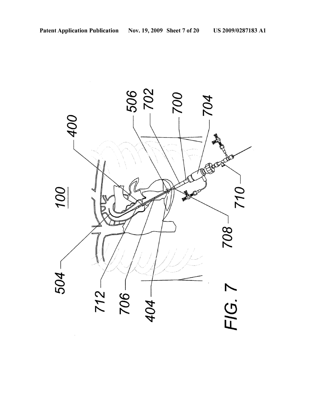 EXPANDABLE TRANSAPICAL SHEATH AND METHOD OF USE - diagram, schematic, and image 08