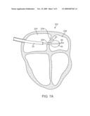 Apparatus and Methods for Retracting an Ablation Balloon diagram and image