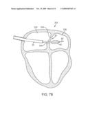 Apparatus and Methods for Retracting an Ablation Balloon diagram and image