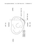 Method and apparatus for performing an open wedge, high tibial osteotomy diagram and image