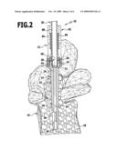 IMPLANT AND IMPLANTATION SYSTEM diagram and image