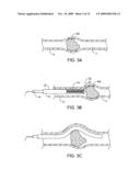 METHODS AND APPARATUS FOR DEPLOYING SHORT LENGTH URETERAL STENTS diagram and image