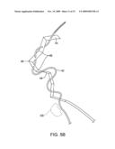 METHODS AND APPARATUS FOR DEPLOYING SHORT LENGTH URETERAL STENTS diagram and image