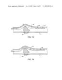 METHODS AND APPARATUS FOR DEPLOYING SHORT LENGTH URETERAL STENTS diagram and image