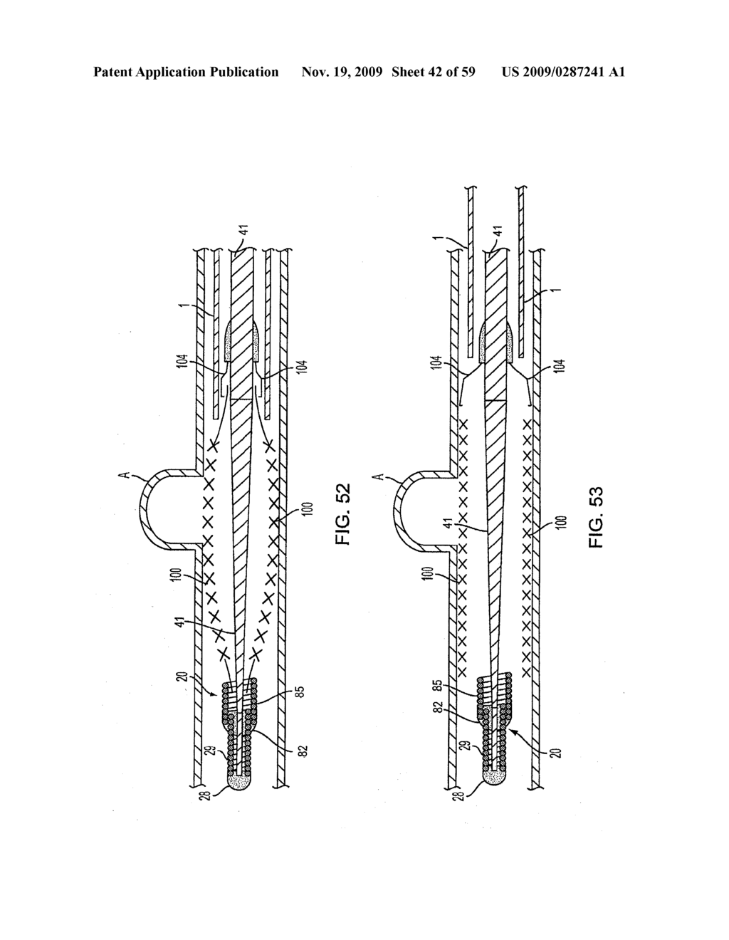 METHODS AND APPARATUS FOR LUMINAL STENTING - diagram, schematic, and image 43