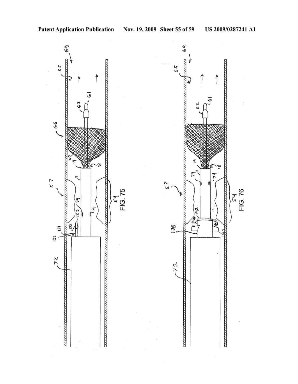 METHODS AND APPARATUS FOR LUMINAL STENTING - diagram, schematic, and image 56