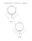 Braid-Ball Embolic Devices diagram and image