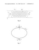 Braid-Ball Embolic Devices diagram and image