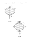 Braid-Ball Embolic Devices diagram and image