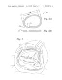 PHYSIOLOGICALLY HARMONIZED TRICUSPID ANNULOPLASTY RING diagram and image