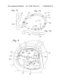 PHYSIOLOGICALLY HARMONIZED TRICUSPID ANNULOPLASTY RING diagram and image