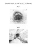 Method for treatment of overfiltering and leaking blebs with sterile talc diagram and image