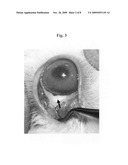 Method for treatment of overfiltering and leaking blebs with sterile talc diagram and image