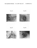 Method for treatment of overfiltering and leaking blebs with sterile talc diagram and image