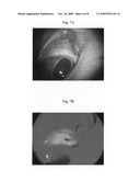 Method for treatment of overfiltering and leaking blebs with sterile talc diagram and image