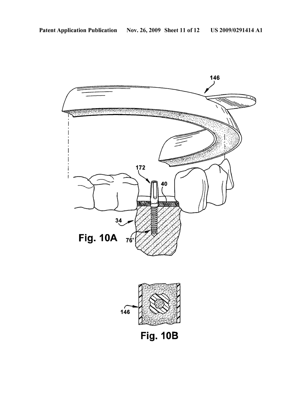 METHOD FOR FORMING A DENTAL IMPLANT - diagram, schematic, and image 12