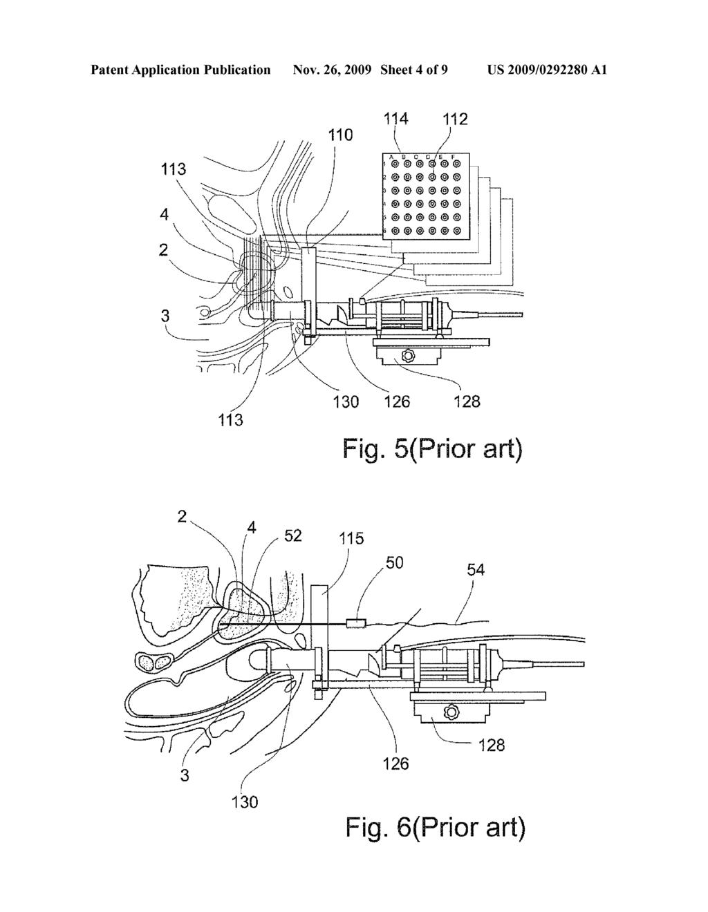 APPARATUS AND METHOD FOR PROTECTING TISSUES DURING CRYOABLATION - diagram, schematic, and image 05