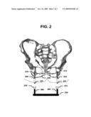 System and Method for Supporting The Weight Of A Body Using Osseopercutaneous Implants diagram and image