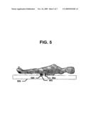 System and Method for Supporting The Weight Of A Body Using Osseopercutaneous Implants diagram and image