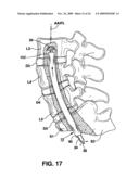 METHODS AND APPARATUS FOR TOOLS IN AXIALLY ORIENTED BORES THROUGH SPINAL VERTEBRAE diagram and image