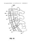 METHODS AND APPARATUS FOR TOOLS IN AXIALLY ORIENTED BORES THROUGH SPINAL VERTEBRAE diagram and image