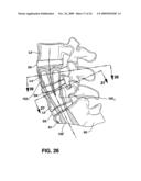 METHODS AND APPARATUS FOR TOOLS IN AXIALLY ORIENTED BORES THROUGH SPINAL VERTEBRAE diagram and image