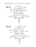 METHODS AND APPARATUS FOR TOOLS IN AXIALLY ORIENTED BORES THROUGH SPINAL VERTEBRAE diagram and image