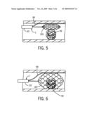 Devices for Restoring Blood Flow and Embolus Removal During Acute Ischemic Stroke diagram and image