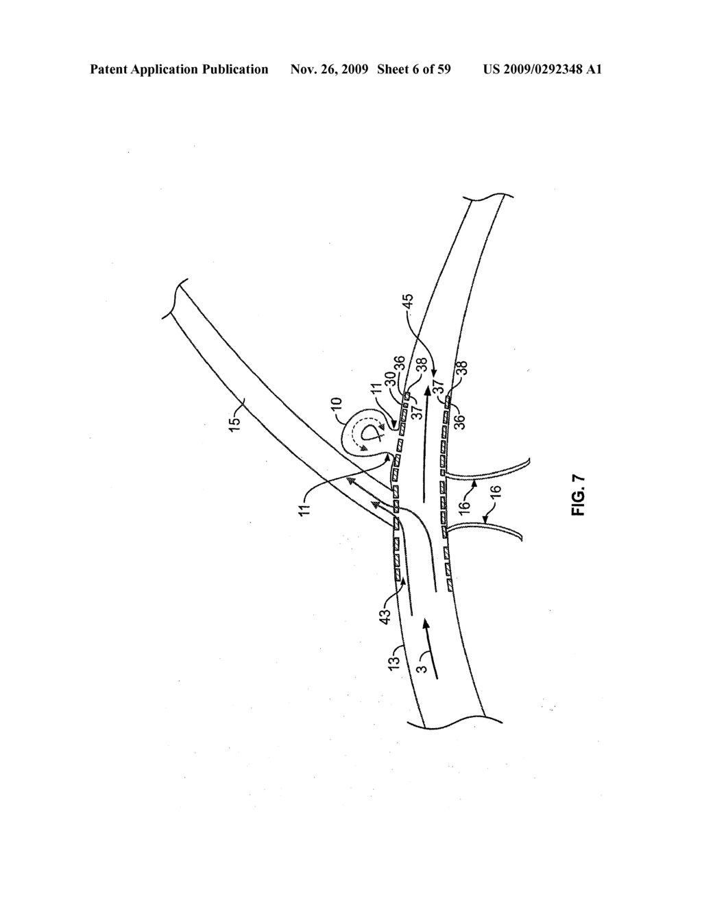 VASCULAR STENTING AND OTHER PROCEDURES - diagram, schematic, and image 07