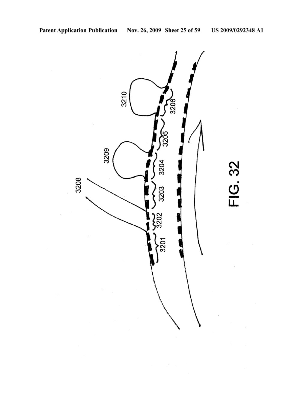 VASCULAR STENTING AND OTHER PROCEDURES - diagram, schematic, and image 26