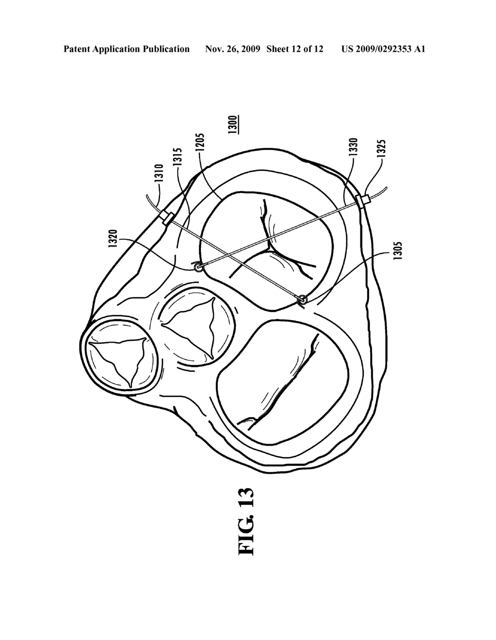 SYSTEMS AND METHODS TO CONTROL THE DIMENSION OF A HEART VALVE - diagram, schematic, and image 13