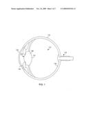 REDUCED PROFILE INTRAOCULAR LENS diagram and image