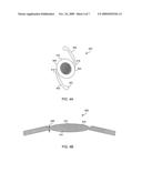 REDUCED PROFILE INTRAOCULAR LENS diagram and image