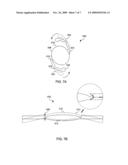 REDUCED PROFILE INTRAOCULAR LENS diagram and image