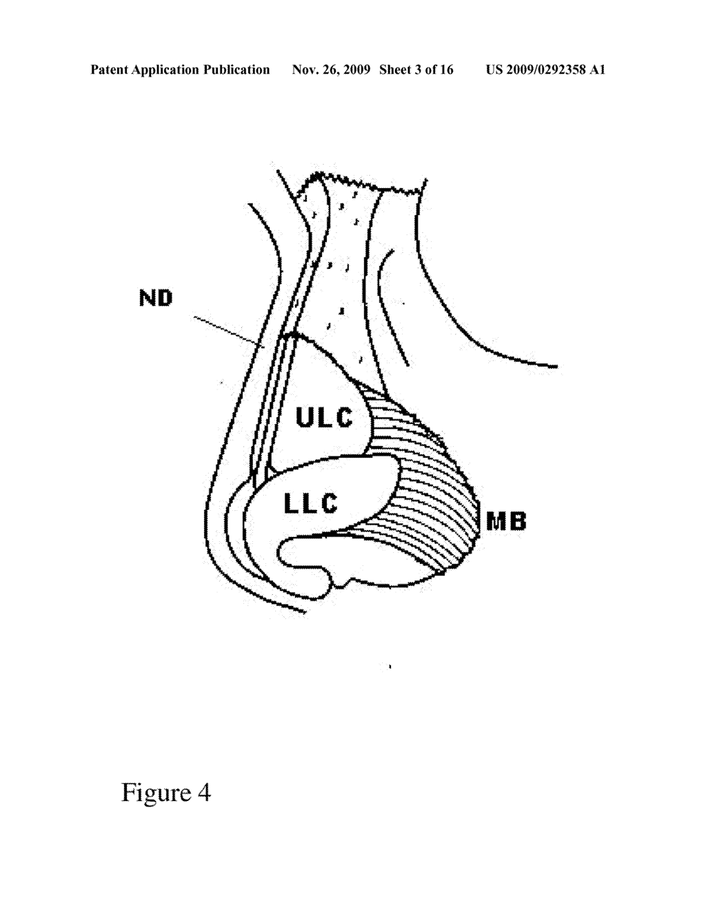 Nasal implant introduced through a non-surgical injection technique - diagram, schematic, and image 04