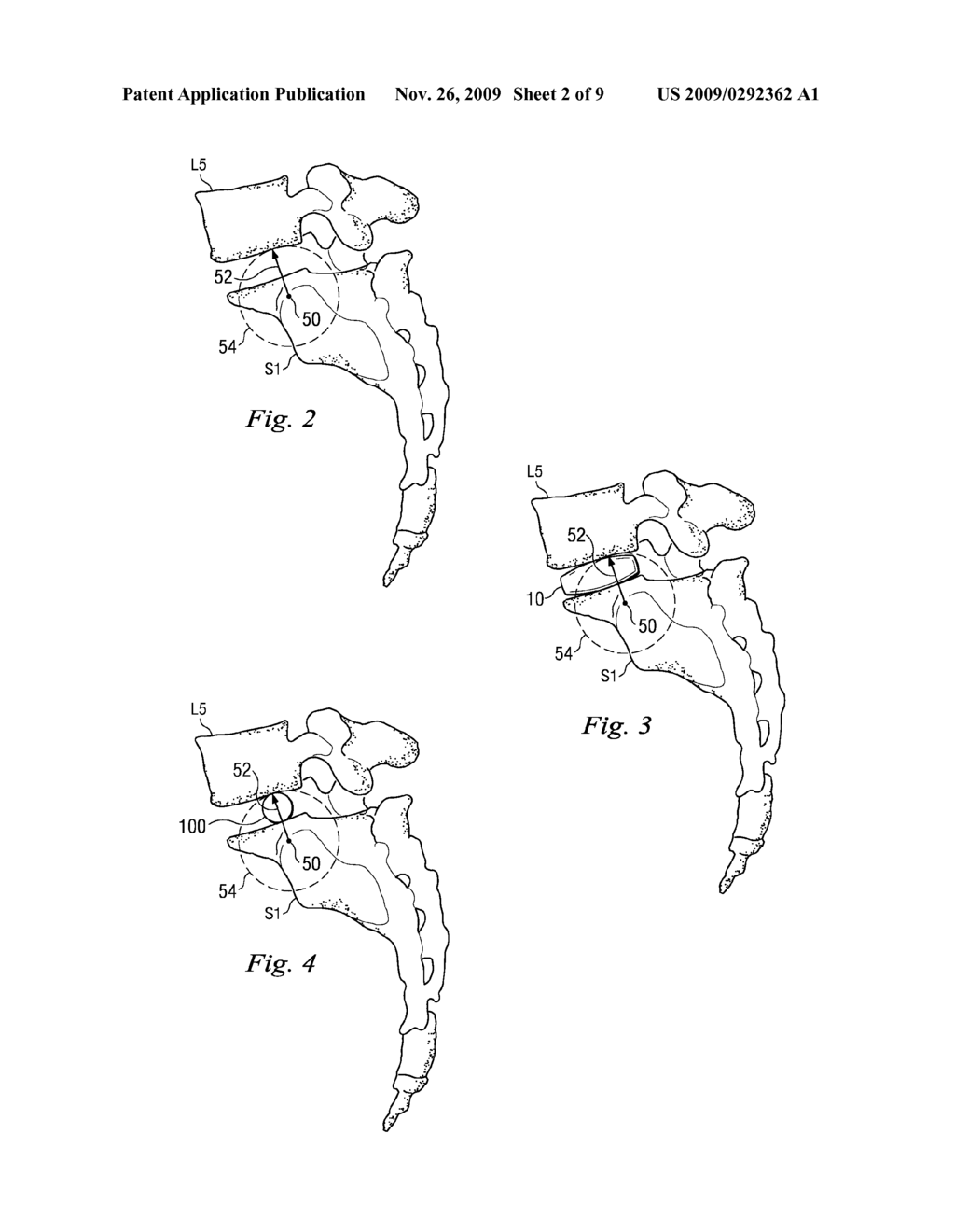 INTERVERTEBRAL IMPLANT AND METHODS OF IMPLANTATION AND MANUFACTURE - diagram, schematic, and image 03