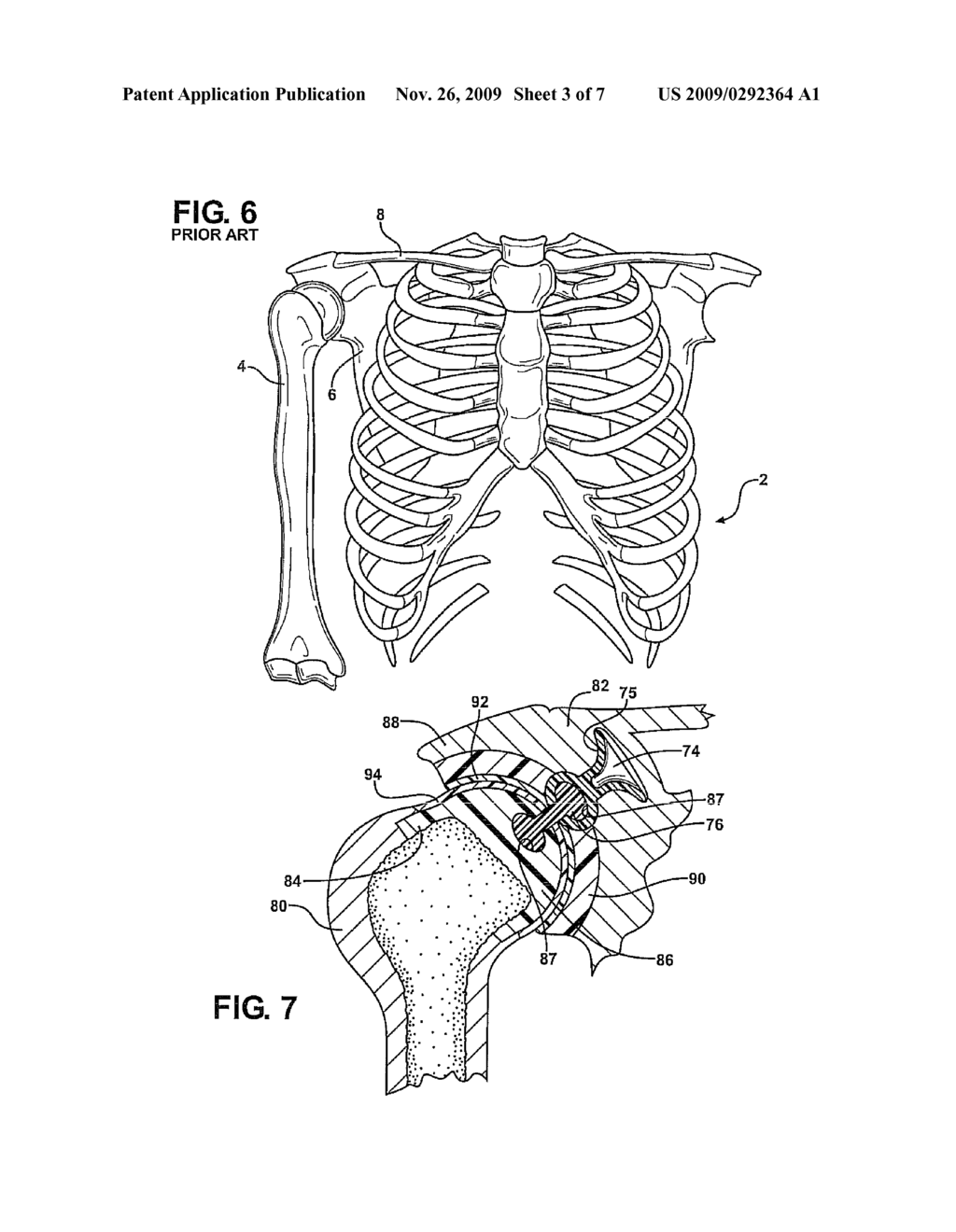 SHOULDER IMPLANT WITH FIRST AND SECOND COMPOSITE SUB-ASSEMBLIES AND IMPROVED MOUNTING ANCHORS FOR ESTABLISHING A SECURE JOINT - diagram, schematic, and image 04