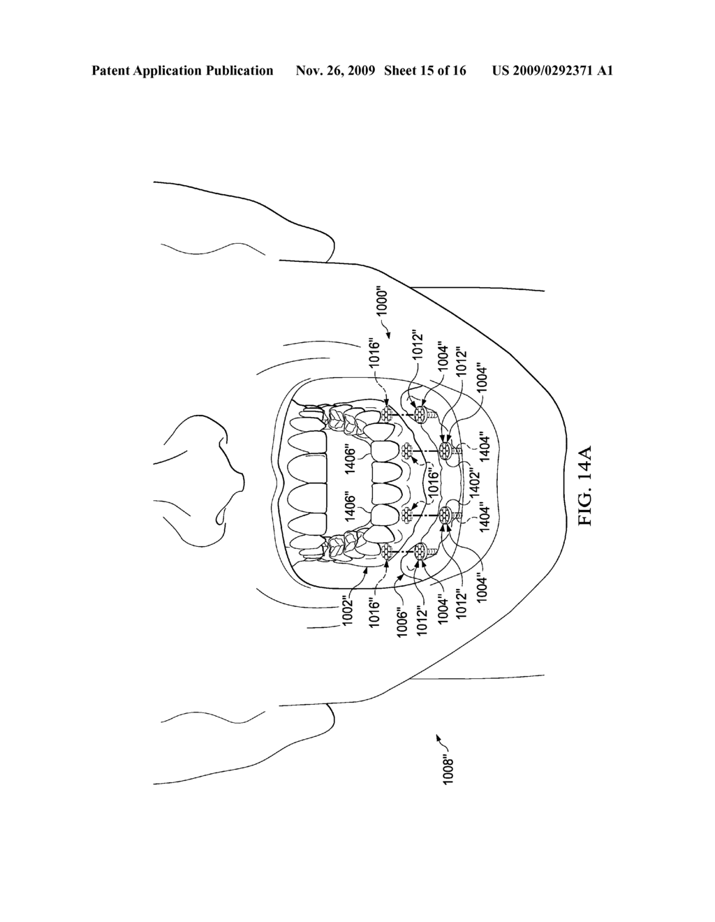 Correlated Magnetic Prosthetic Device and Method for Using the Correlated Magnetic Prosthetic Device - diagram, schematic, and image 16