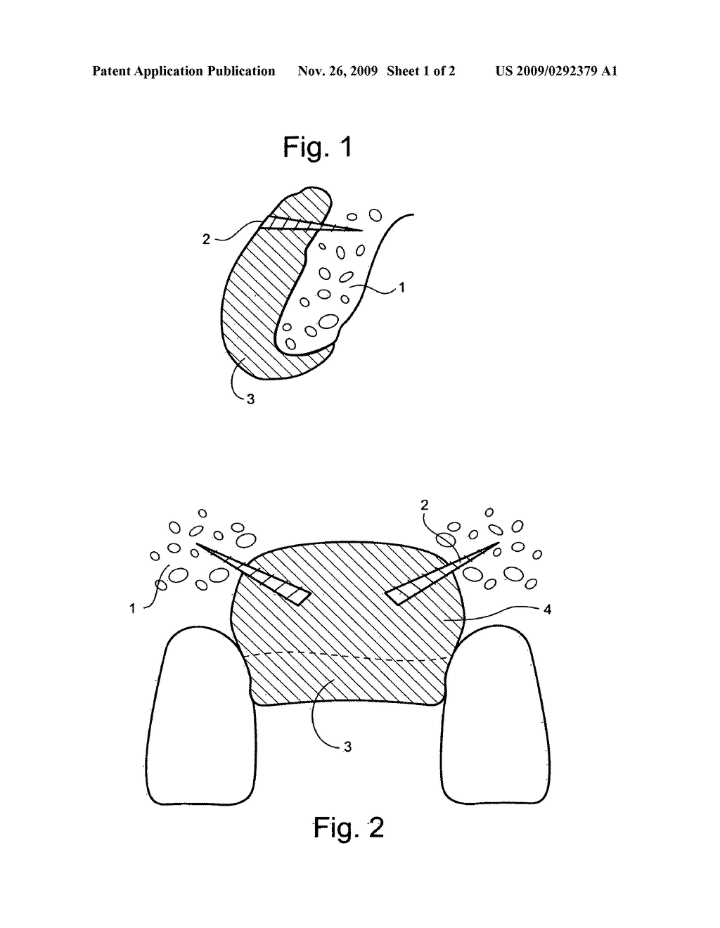 Automated machining of dental block grafts and machining of biocompatible material for bone augmentation - diagram, schematic, and image 02